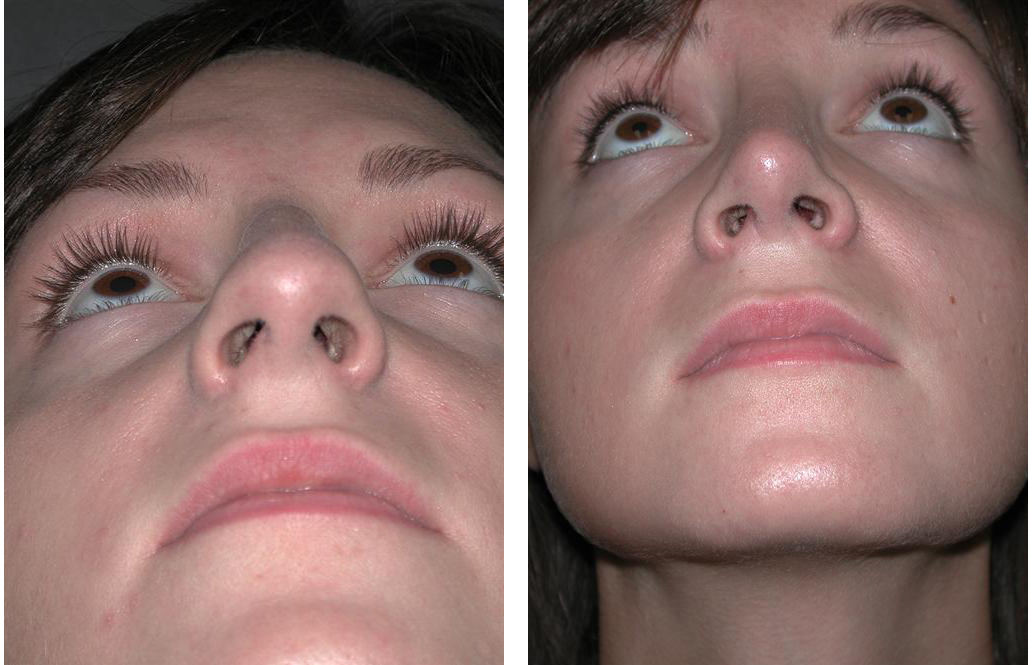Before and after photos of Newmarket Rhinoplasty