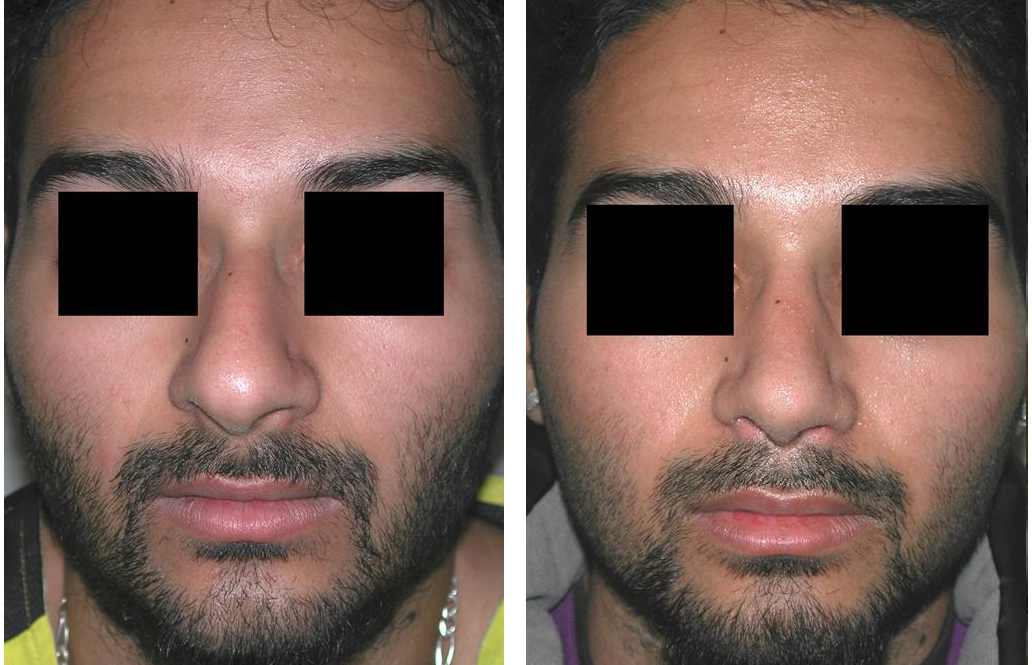 Male nose job by Dr. Richard Rival