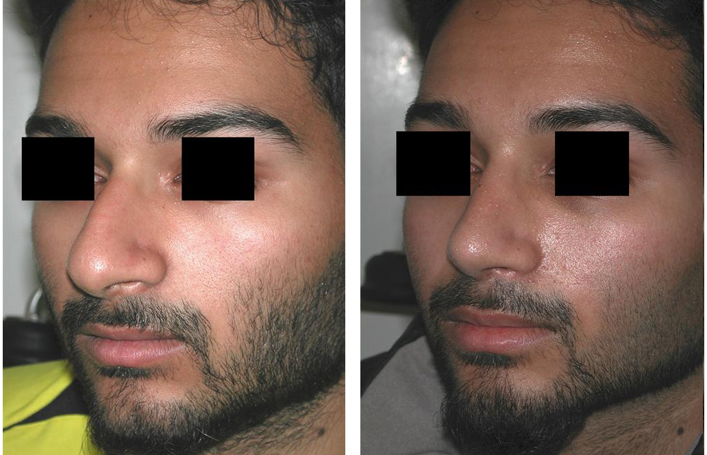 Rhinoplasty by Toronto cosmetic surgeon Dr. Rival
