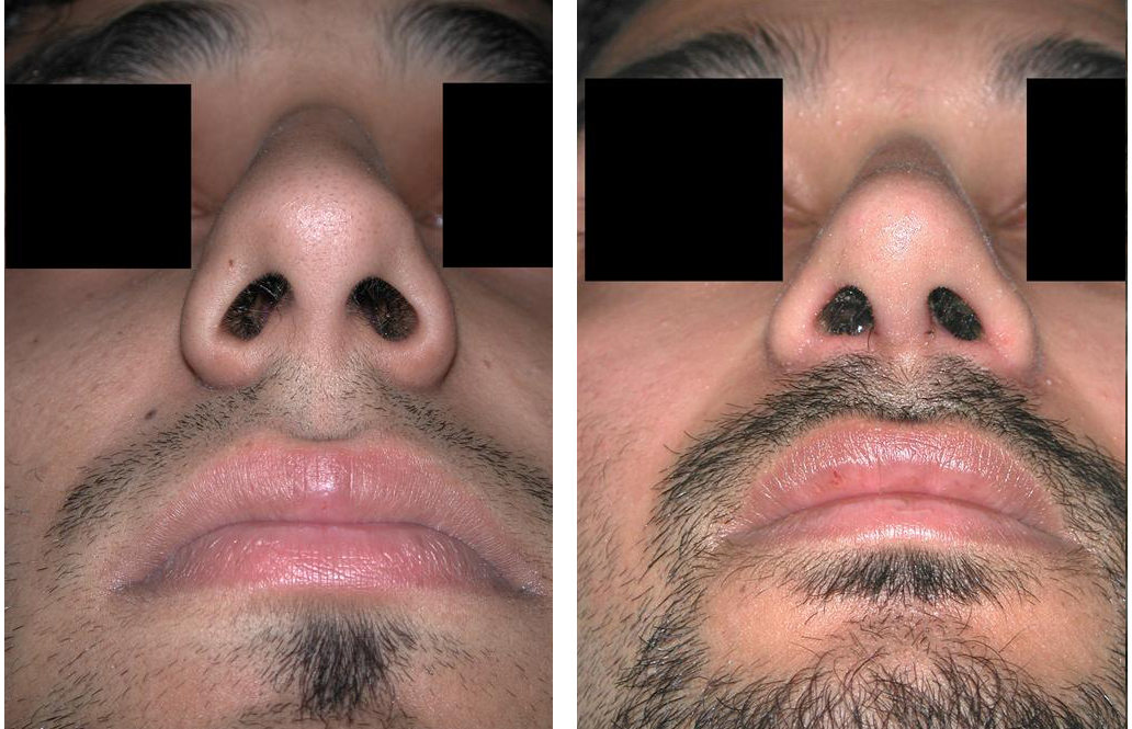 Toronto rhinoplasty by Facial Cosmetic Surgeon Dr. Rival