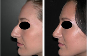Before and after photos of female nose job in Toronto