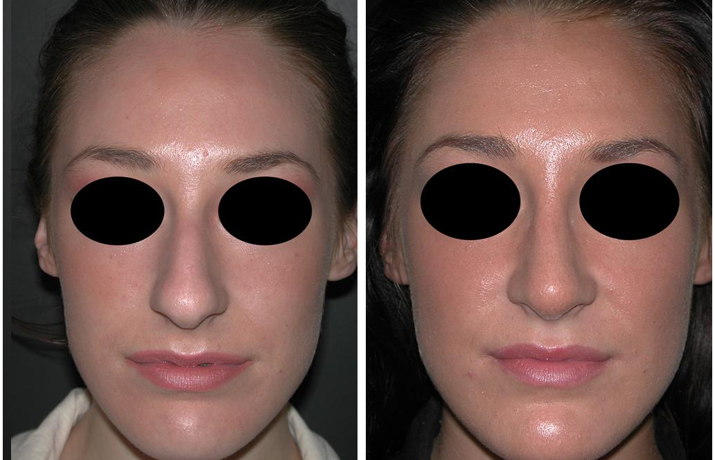 Before and after photos of female nose job in Newmarket