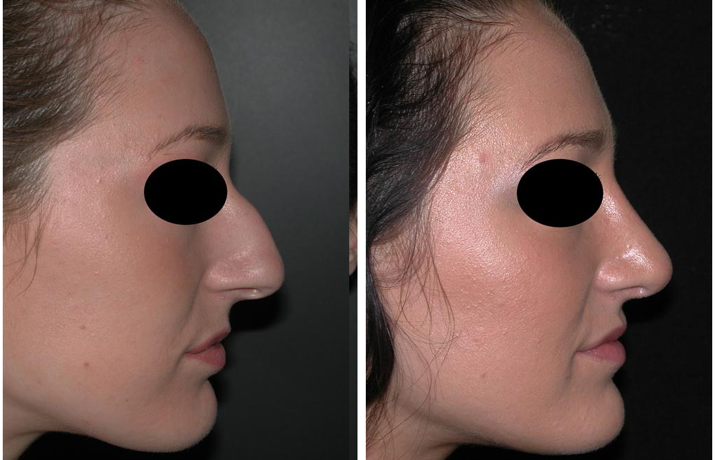 Before and after photos of female Rhinoplasty in Toronto