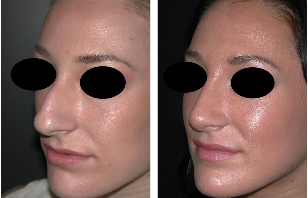 Before and after photos of female rhinoplasty in Newmarket