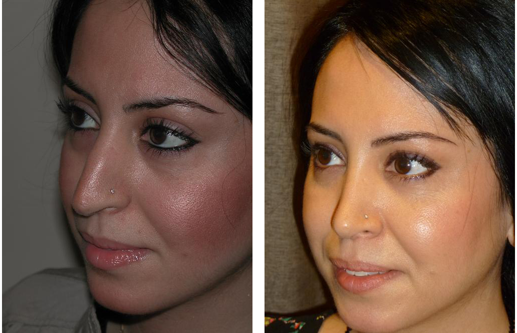 Toronto rhinoplasty done by cosmetic surgeon Dr. Richard Rival