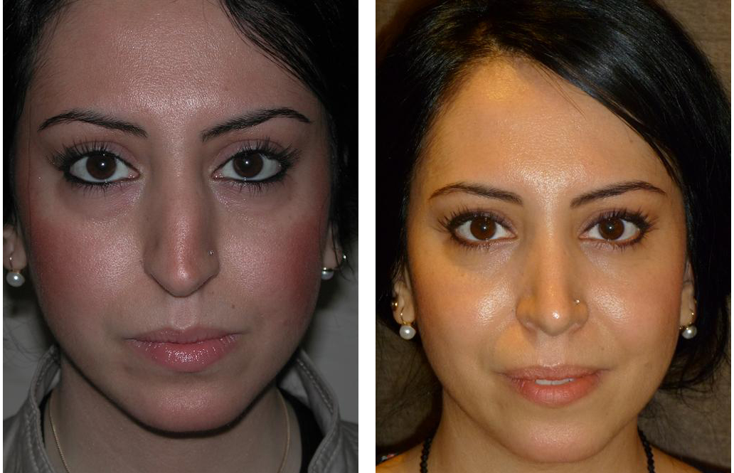 Nose job before and after by Dr. Richard Rival, Toronto's best Cosmetic Surgeon