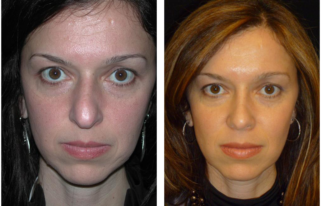 Before and after nose job by best plastic surgeon in toronto