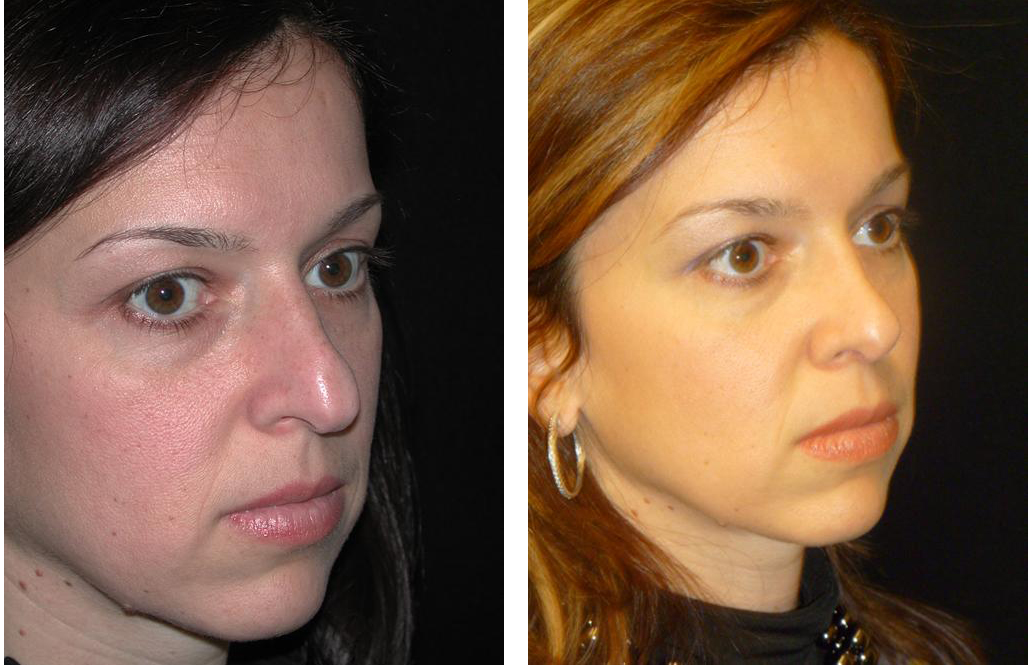 Toronto's best plastic surgeon's rhinoplasty before and after