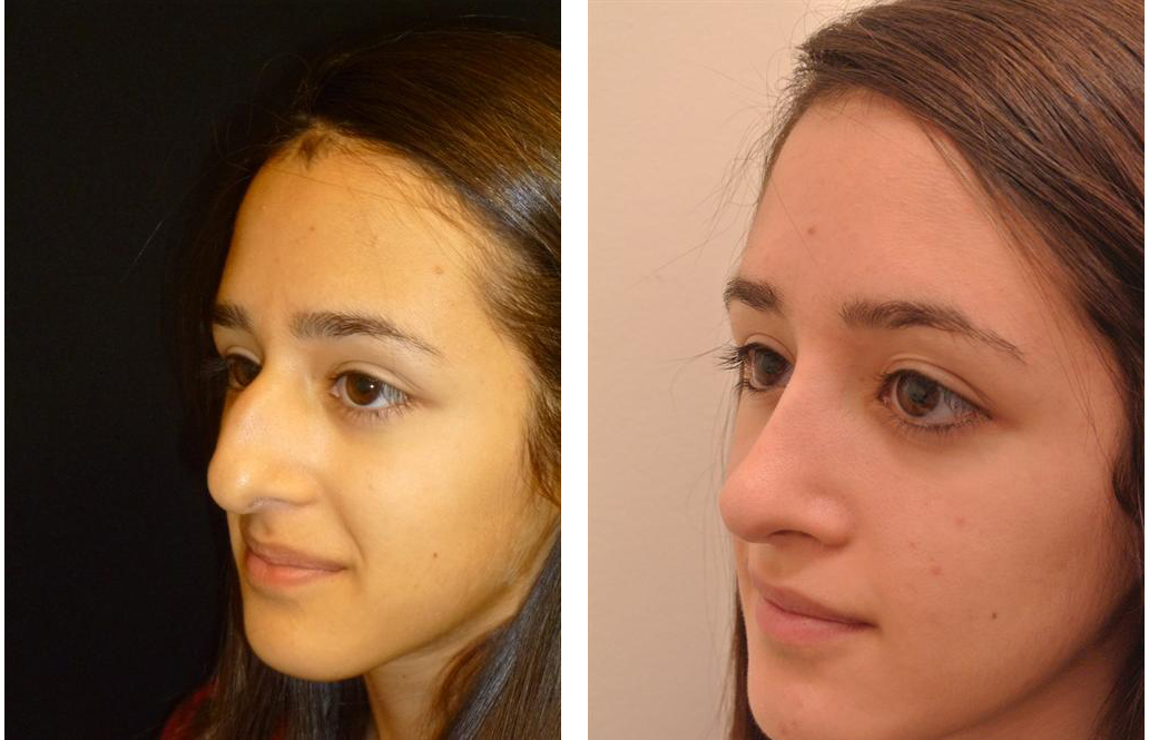 Before and after Toronto rhinoplasty