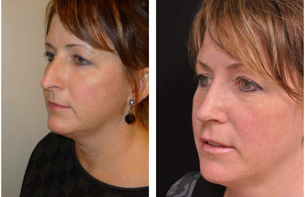 Newmarket rhinoplasty performed on middle aged female