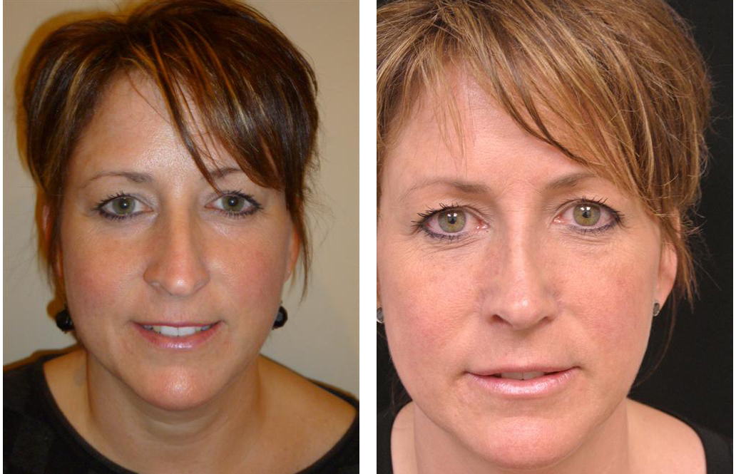 Before and after photos of newmarket nose job by facial cosmetic surgeon Dr. Richard Rival