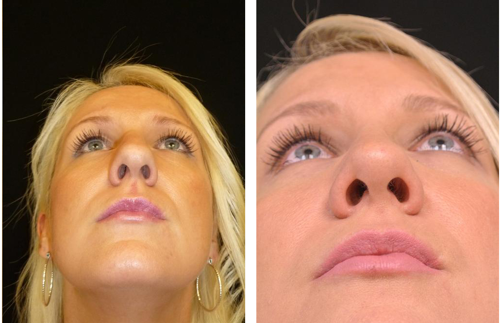Before and after Toronto rhinoplasty surgery