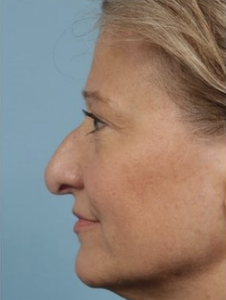 Elderly fair haired woman with hook nose seen in profile